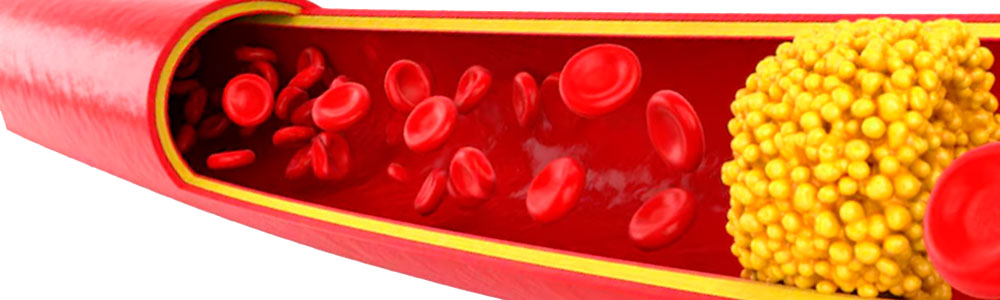 Холестериновые бляшки в сосудах при гипертонии Холестериновые бляшки в сосудах при гипертонии